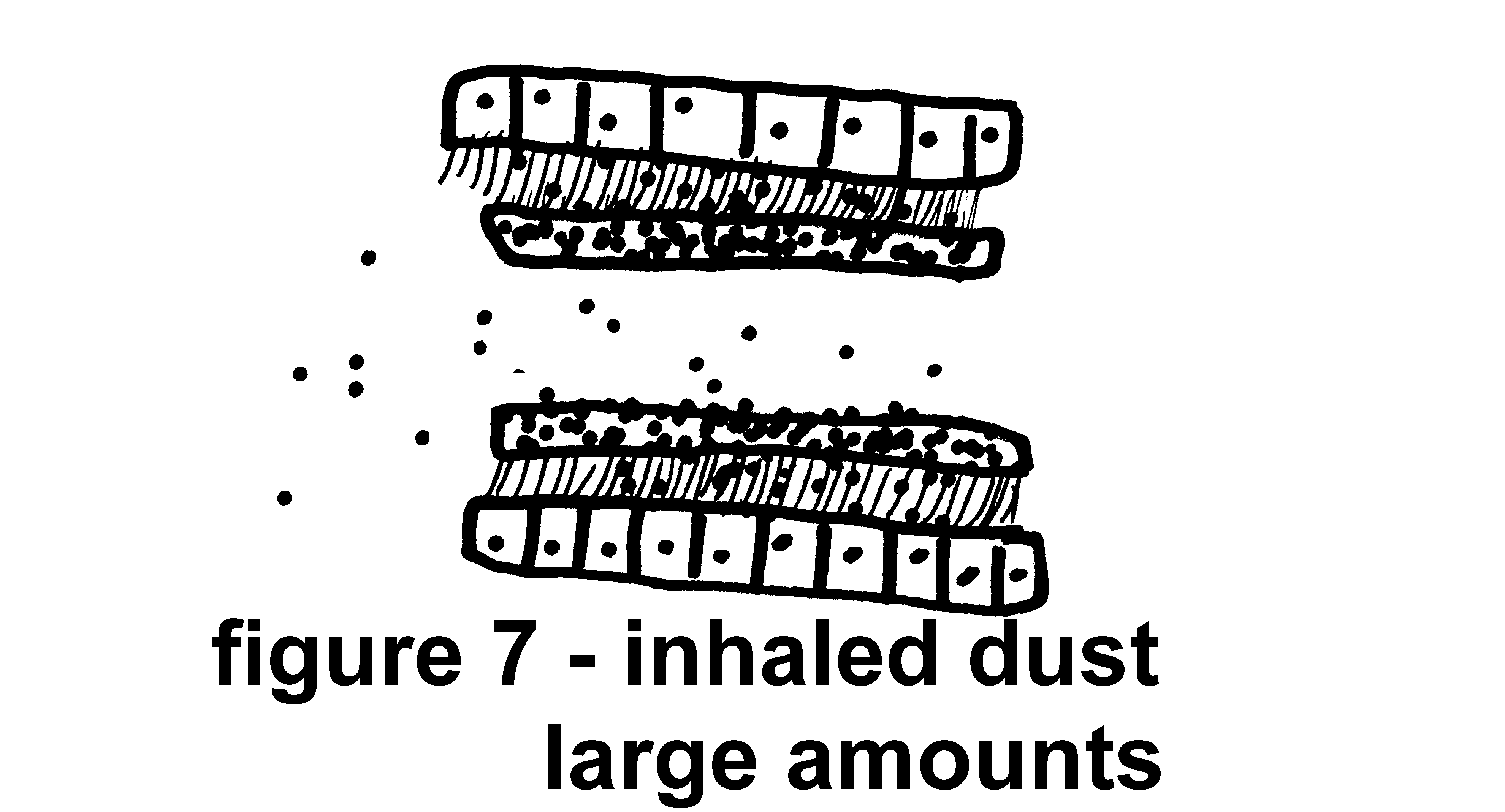 picture of Inhaled dust-large amounts - Quit Smoking - The SMOKING CESSATION CLINIC
